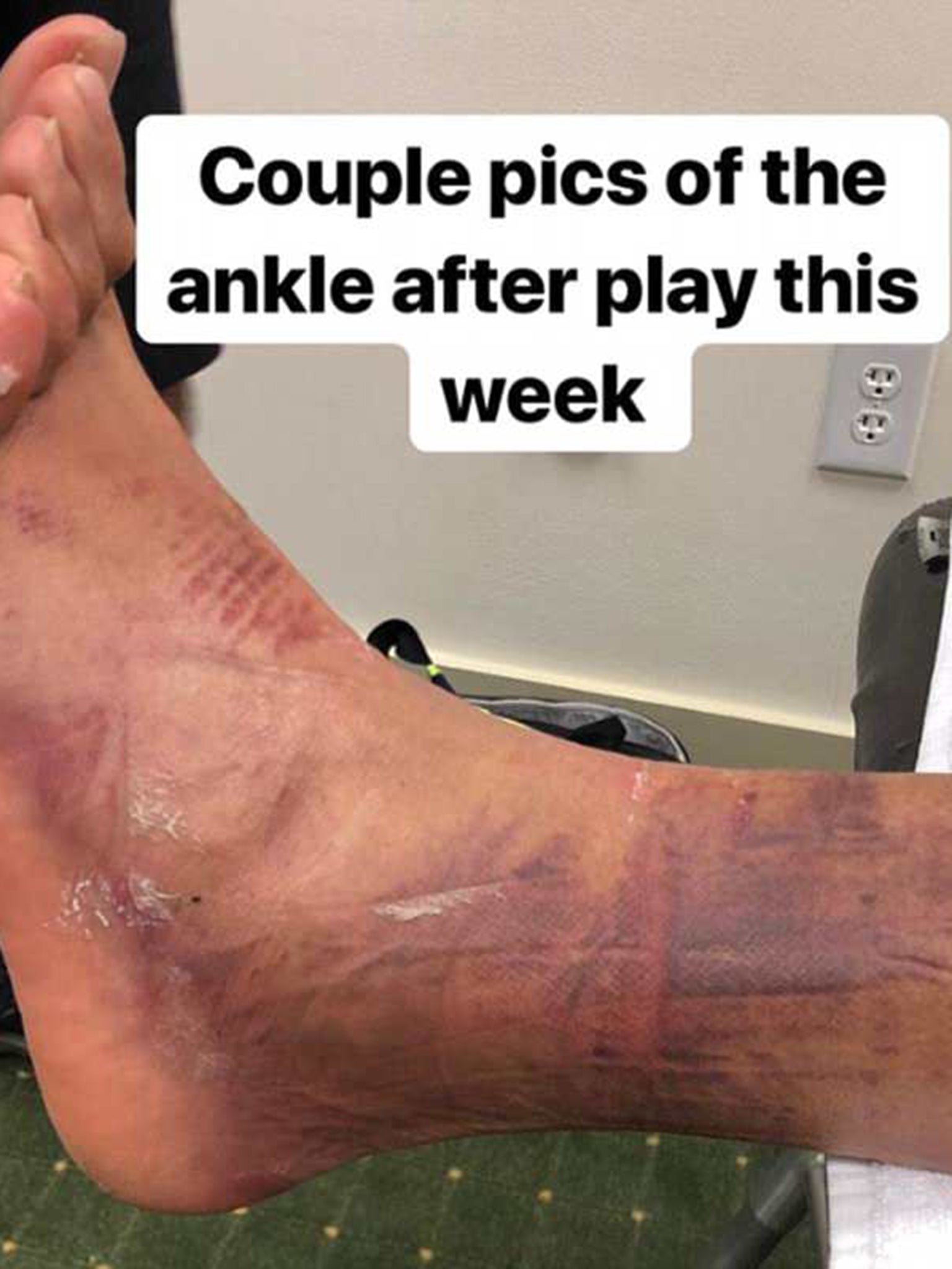 Tony Finau revealed the heavy bruising and swelling that he suffered at The Masters