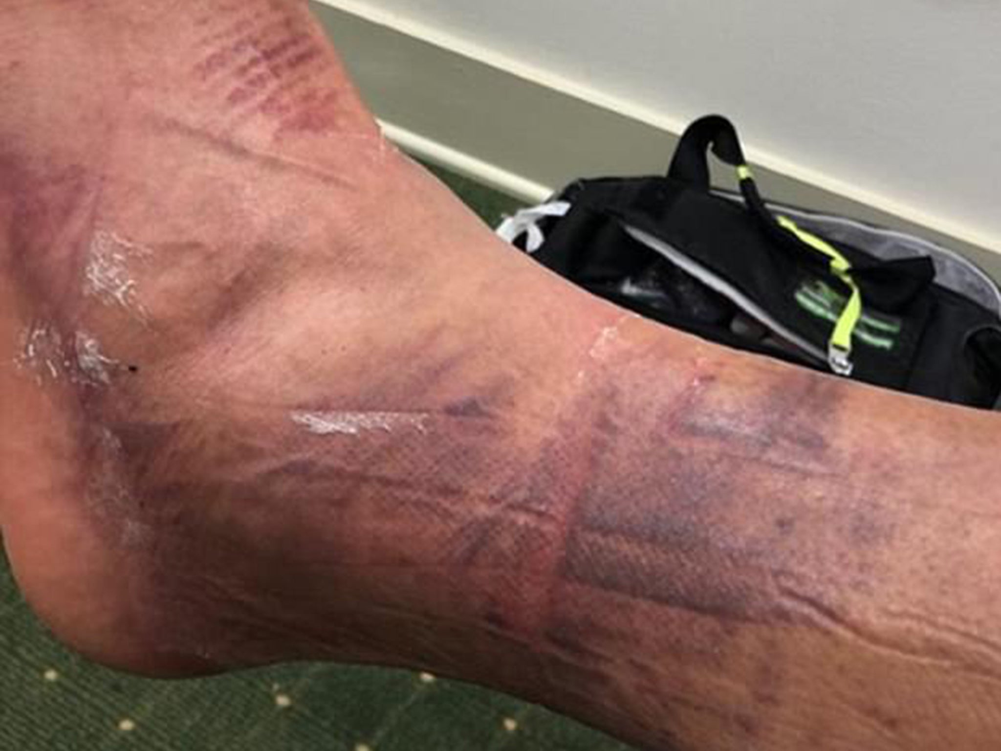 Tony Finau revealed the gruesome injuries that he suffered in dislocating his ankle before The Masters