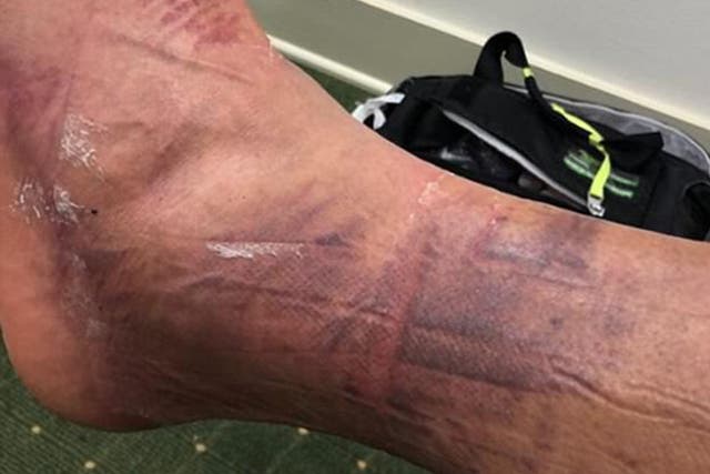Tony Finau revealed the gruesome injuries that he suffered in dislocating his ankle before The Masters