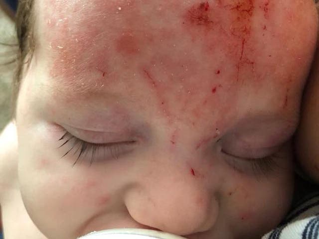 Baby Cash had suffered with red and inflamed skin on his forehead since birth