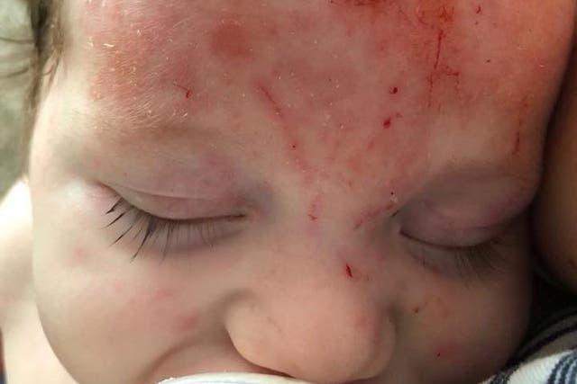 Baby Cash had suffered with red and inflamed skin on his forehead since birth
