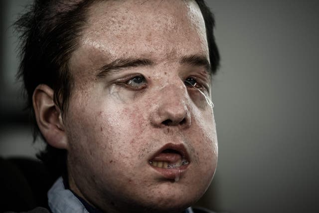 Jerome Hamon is the first person to undergo two face transplants
