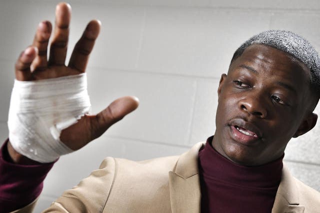 James Shaw Jr, shows his hand that was injured when he disarmed a shooter inside a Waffle House on Sunday, April 22, 2018