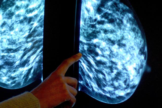 Seventy per cent of women with the most common type of breast cancer could avoid chemotherapy