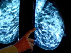 Breast cancer test can ‘predict chances of disease return 20 years on’
