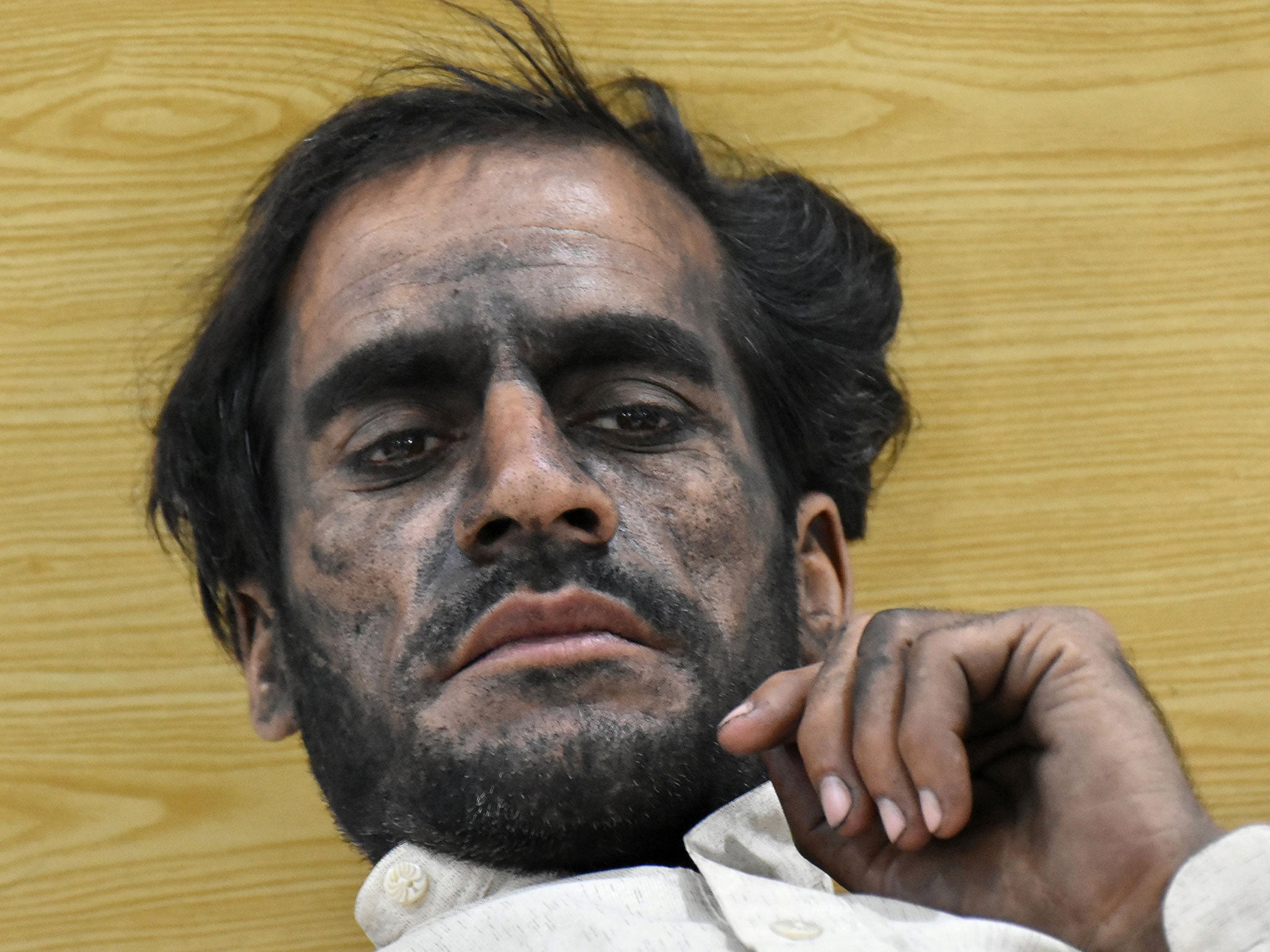 A worker who survived after a coal mine explosion rests at a hospital in Quetta, Pakistan