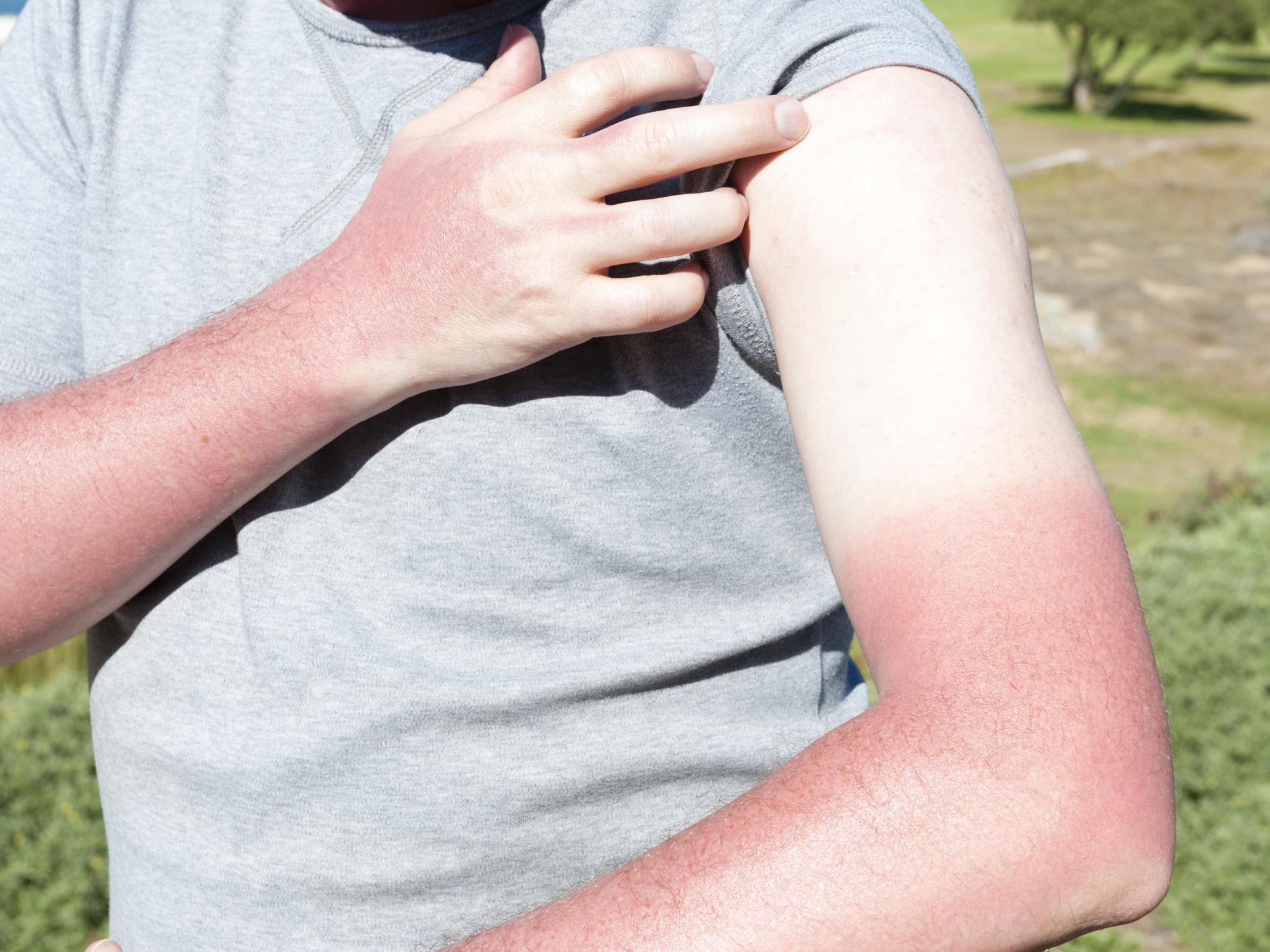 Scientists have found genes that are involved in sunburn and tanning