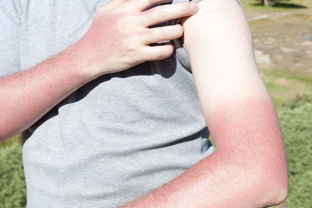 Man showing painfullly sunburnt skin.