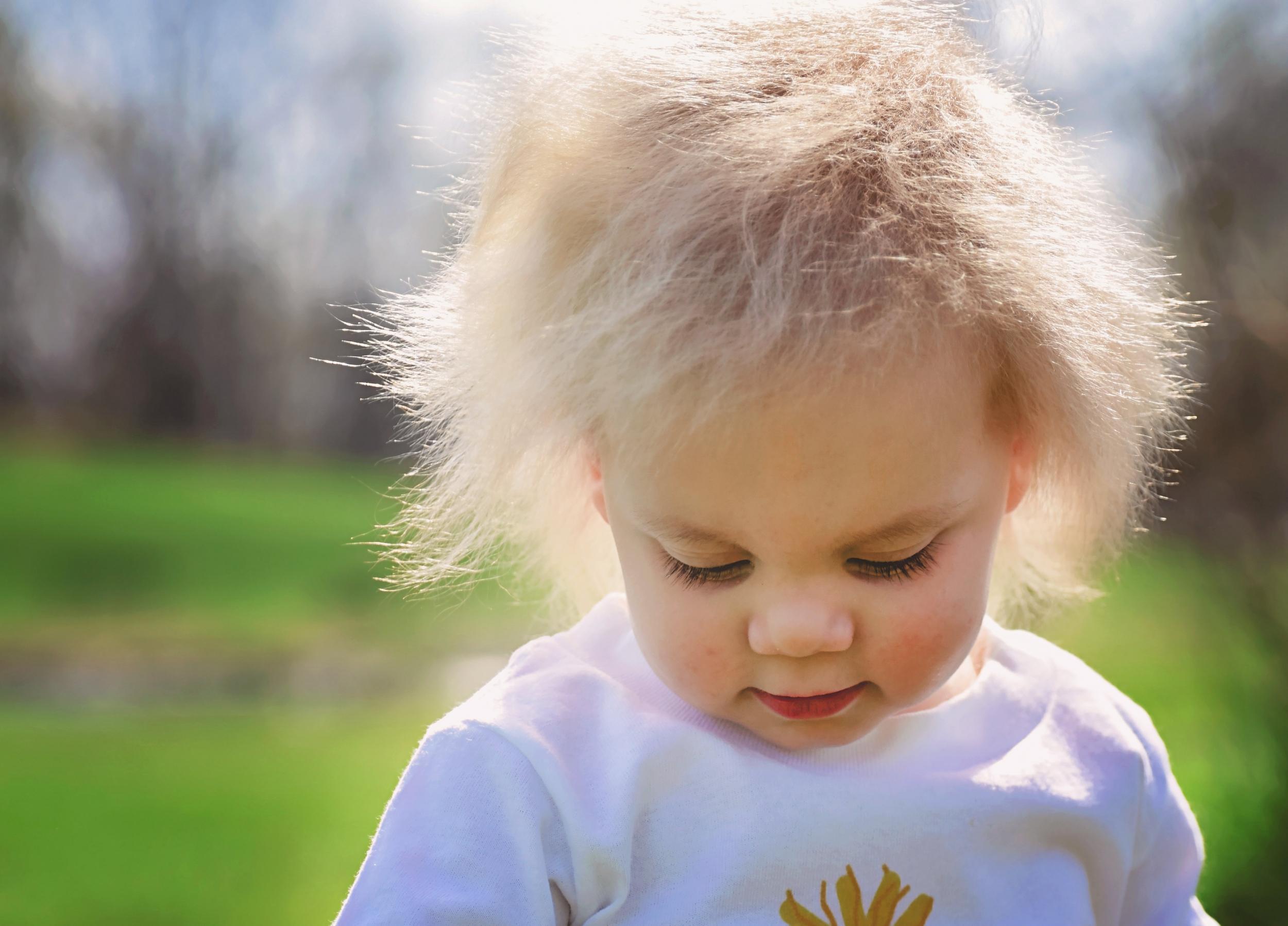 There are around 100 reported cases of 'Uncombable Hair Syndrome' from around the world