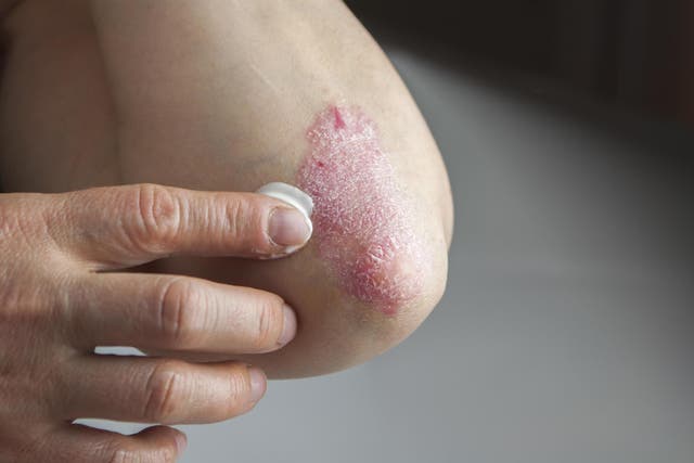 Topical marijuana use can help those suffering from eczema (Stock)