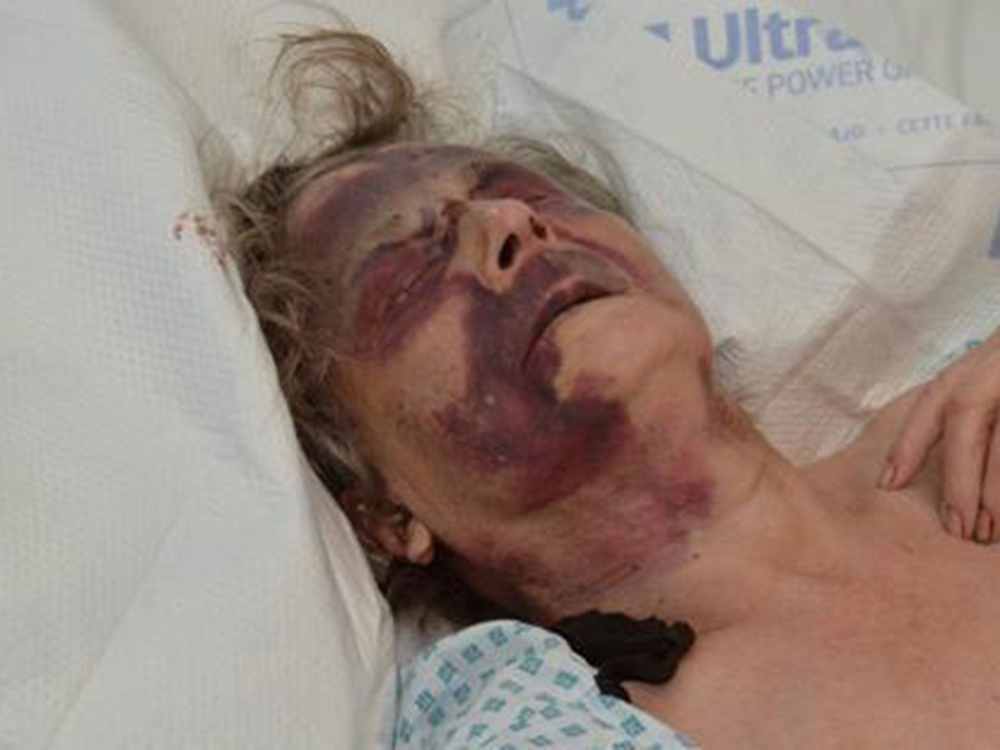 Iris Warner in hospital after the attack