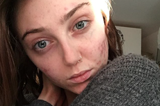 #FreeThePimple is the latest body positivity movement