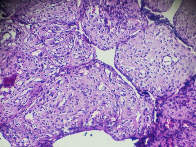 <p>Ovarian cancer can be tricky to spot</p>