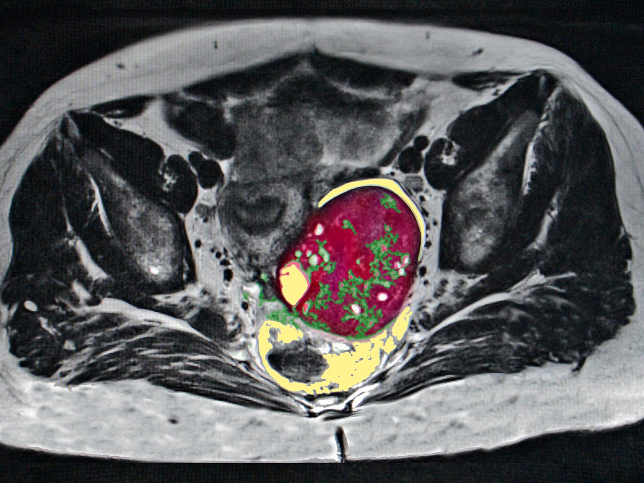 Ultrasound Pictures Of Ovarian Cysts