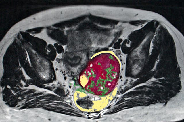 MRI scan showing ovarian cancer