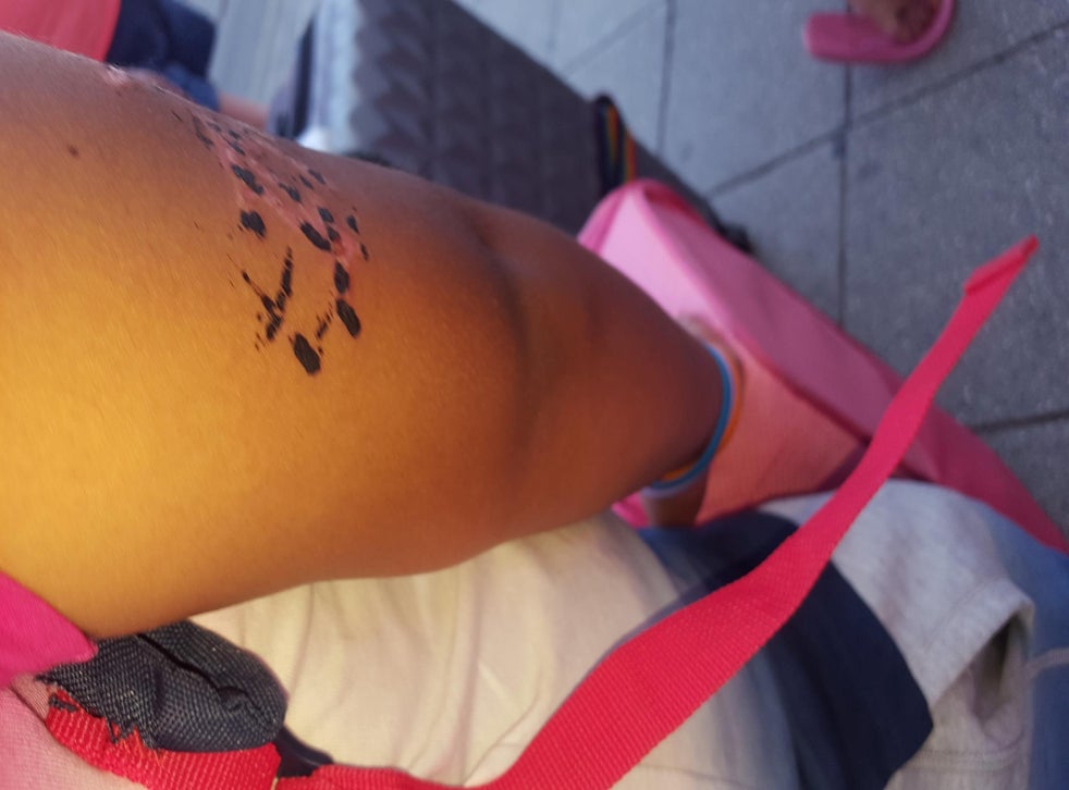 Black Henna Tattoo Warning After Woman S Children Were Left Permanently Scarred The Independent The Independent