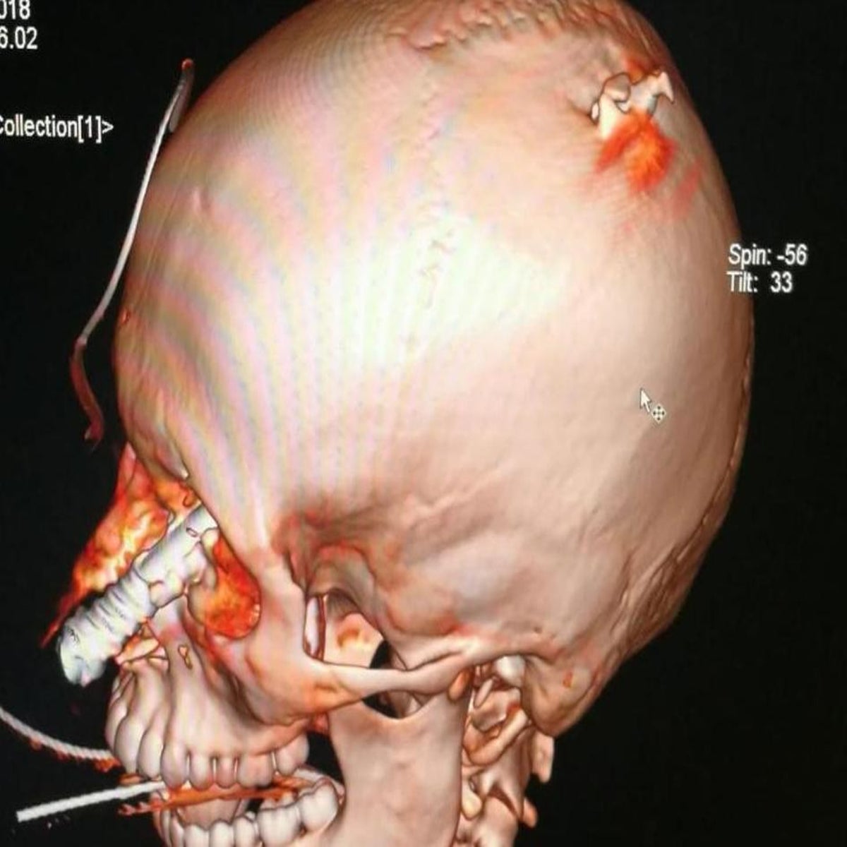 Suicide attempt via spear gun to the head. [Neurosurgery pictures