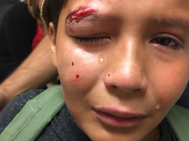 Aiden Vasquez needed stitches after allegedly being beaten up