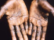 Second ever case of potentially lethal monkey pox found in England