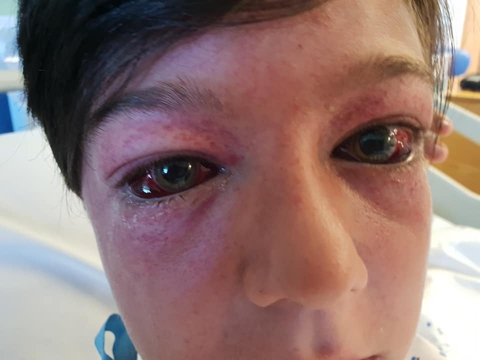 Tyler Broome, 11 from Nottingham, suffered bulging red eyes and spots known as G-measles after suffering high G-force during a stunt on a roundabout