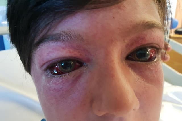 Tyler Broome, 11 from Nottingham, suffered bulging red eyes and spots known as G-measles after suffering high G-force during a stunt on a roundabout