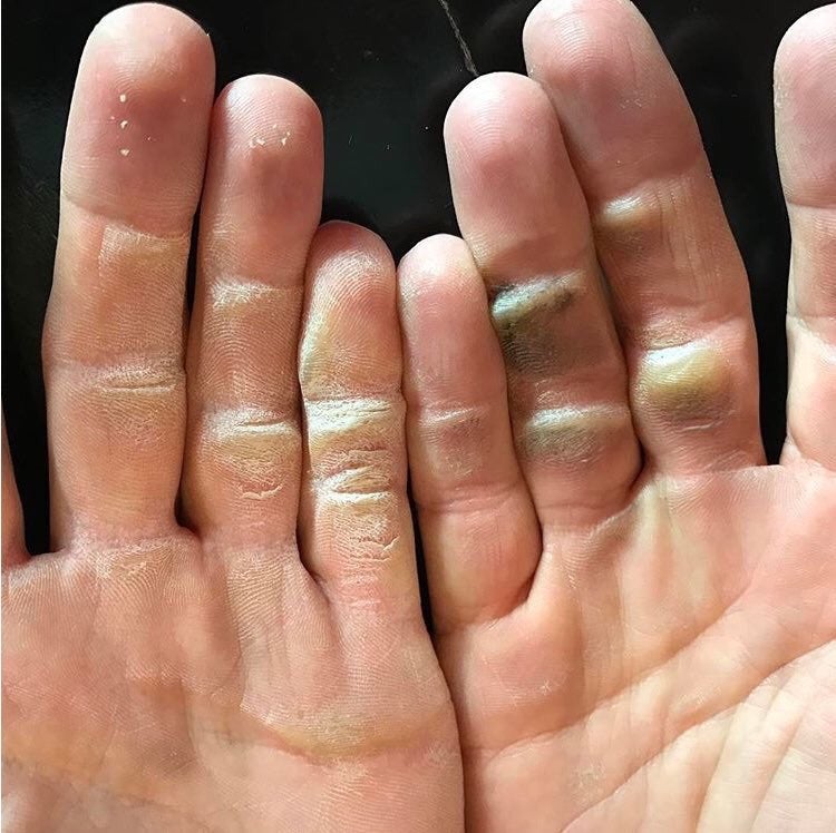 Golf has taken its toll on Alex Noren's hands