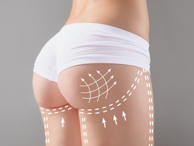 The procedure draws fat from the back or stomach and injects it to reshape the buttocks