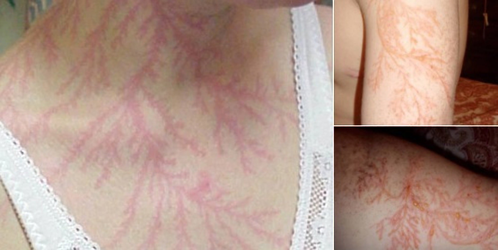 Incredible Photos Show What Can Happen To Your Body If Youre Struck By 