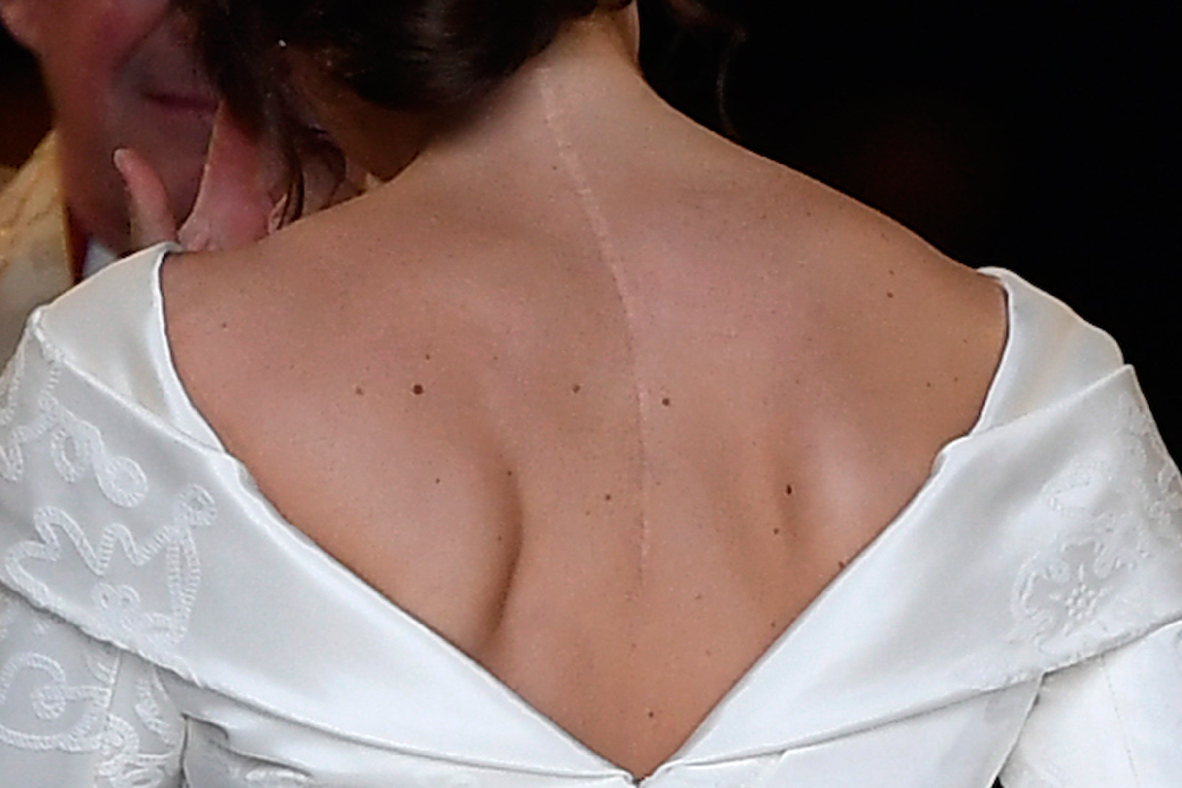 The bride showed off her scar from an operation