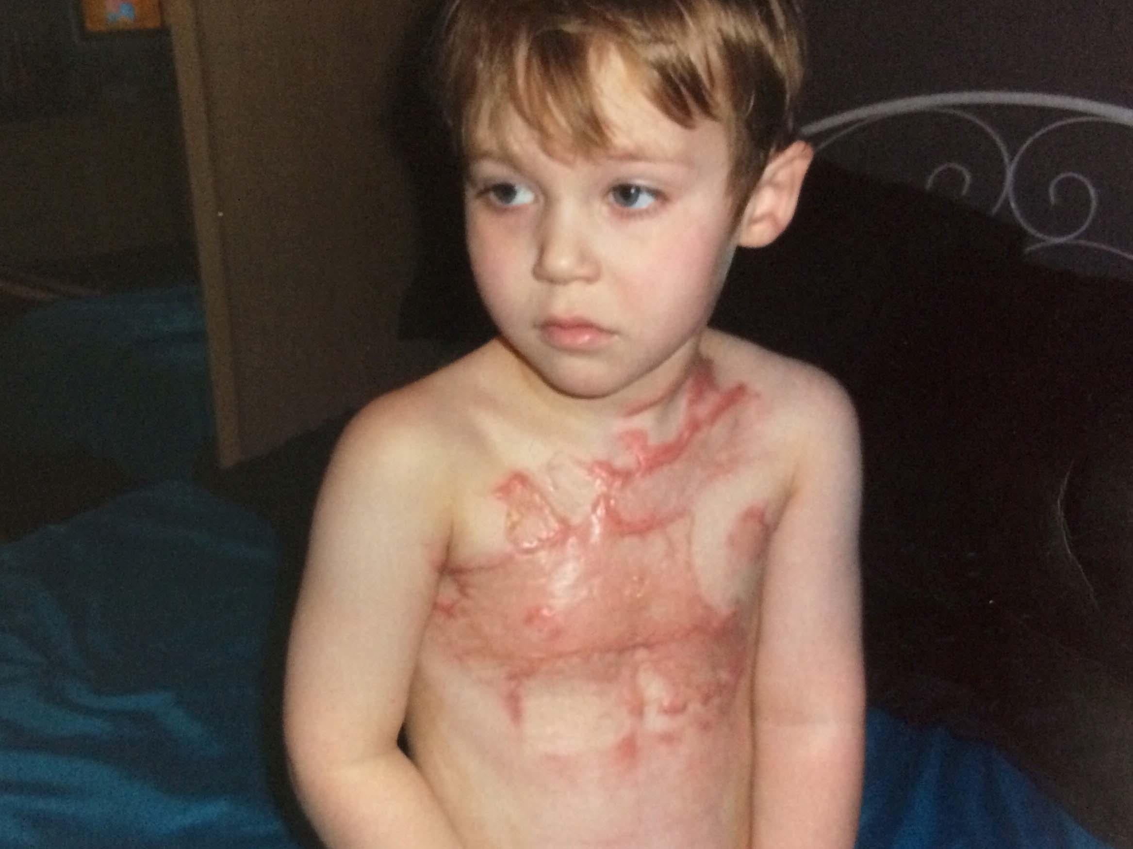 Ben was just four years old when a stray firework landed on him