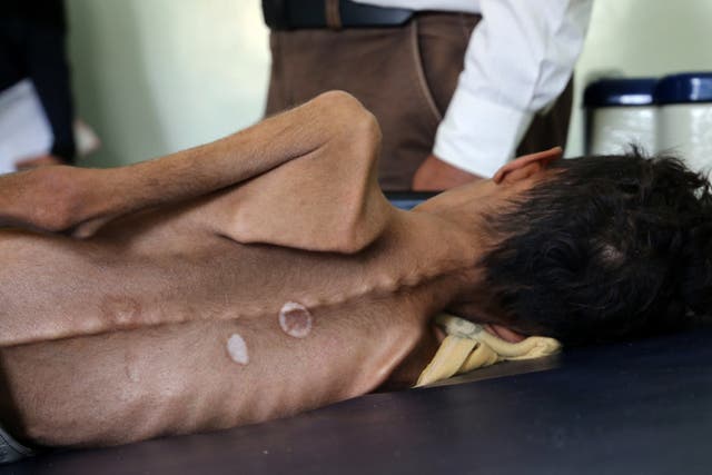 Yemeni boy Ghazi Ali bin Ali, 10, suffering from severe malnutrition lies on a bed in the outskirts of the city of Taiz, on October 30, 2018