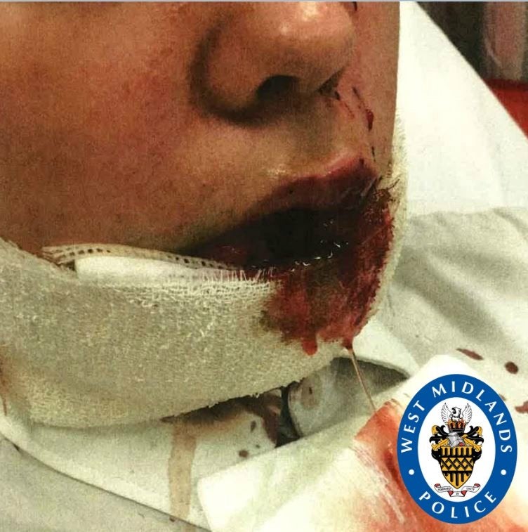 A photo issued by West Midlands Police of a girl who had her lip ripped off by a dog as she walked home
