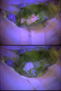 Aggressive cancer cells glow in pink (top) but not apparent in bottom image