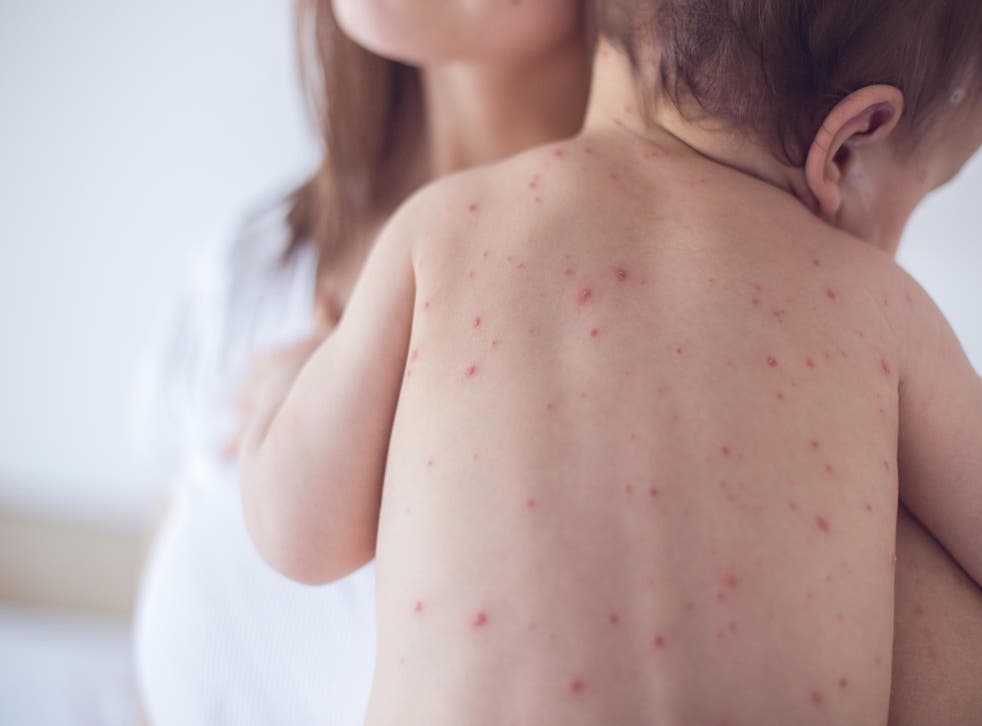 <p>Measles is a highly-contagious viral infection that causes a red rash as one of the symptoms </p>