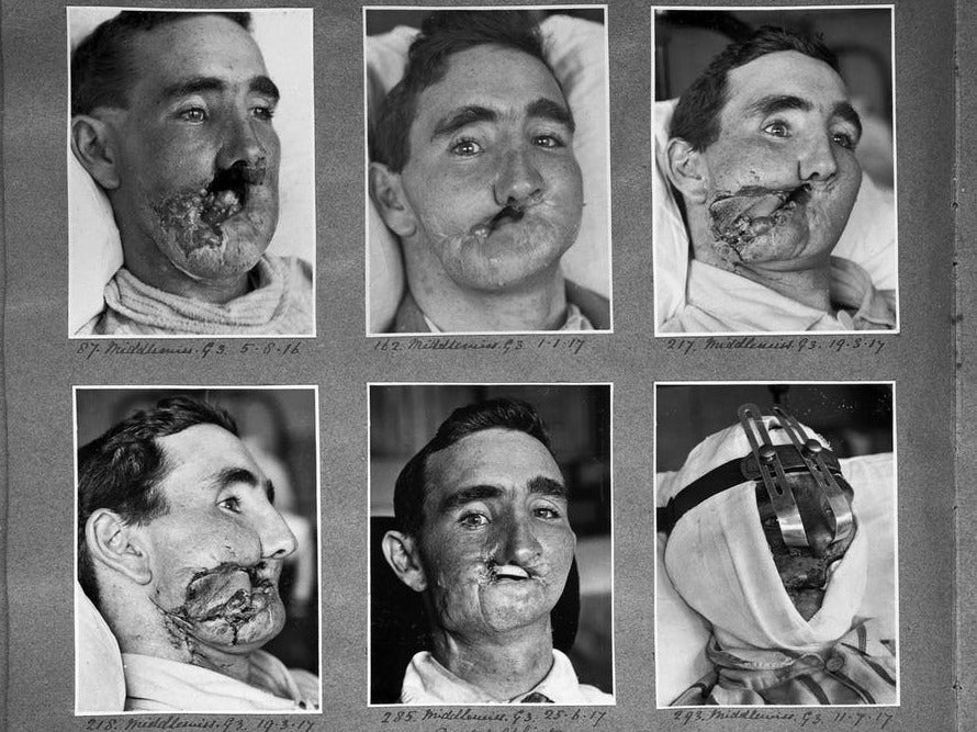 Reconstructive surgery carried out between 1916 and 1918