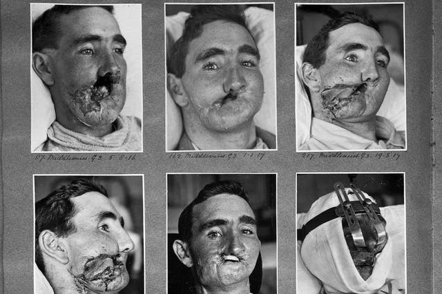 Reconstructive surgery carried out between 1916 and 1918