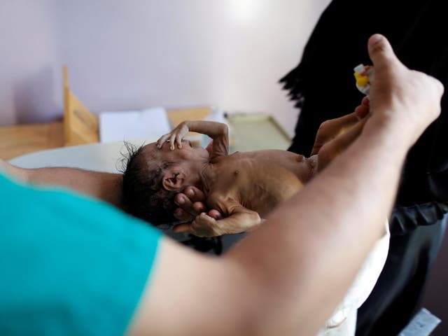 Nurse holds a malnourished child at a malnutrition treatment centre in the capital, Sana'a