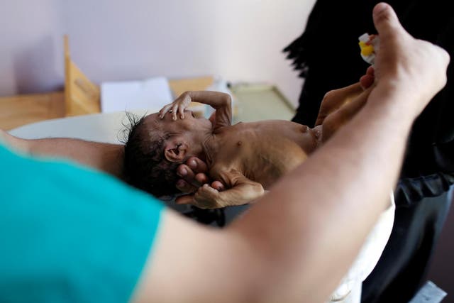 Nurse holds a malnourished child at a malnutrition treatment centre in the capital, Sana'a
