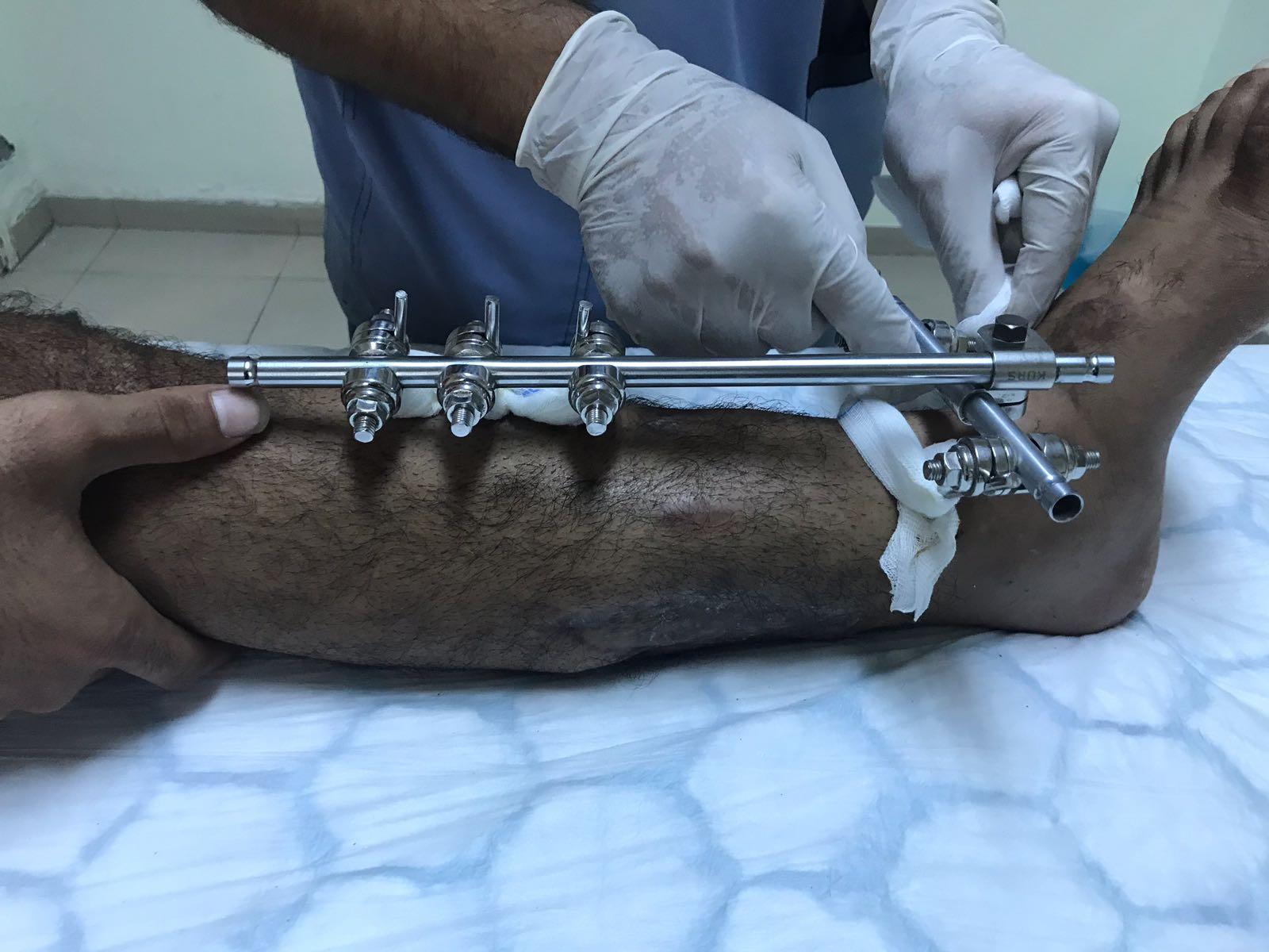 Pins holding together a patient's leg, at the Shifa Hospital in Gaza