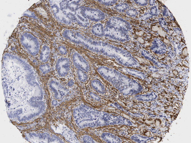 An image of a human carcinoma in the colon showing the fibroblasts
