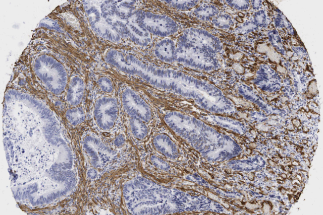 An image of a human carcinoma in the colon showing the fibroblasts