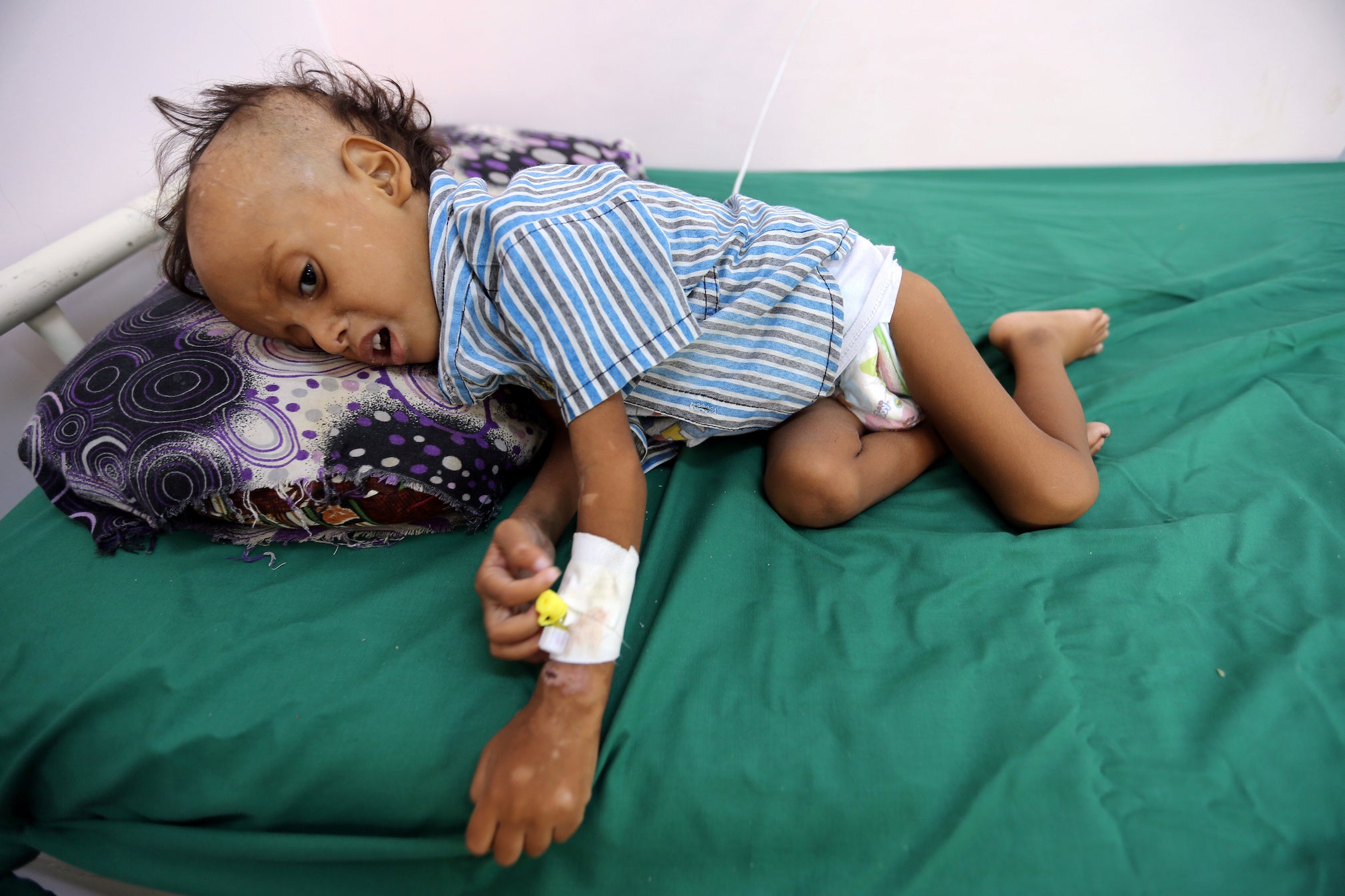 A Yemeni boy, two, is treated for malnutrition earlier this month