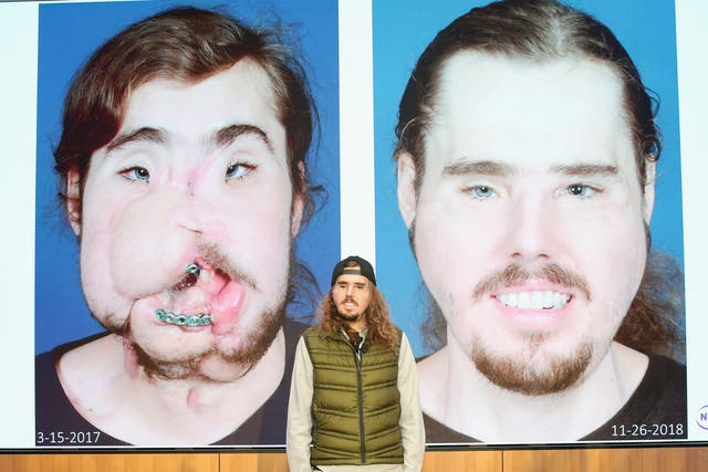 Cameron Underwood poses with the before and after images of his transplant