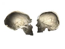 Rare Neanderthal DNA gives some people differently shaped brains