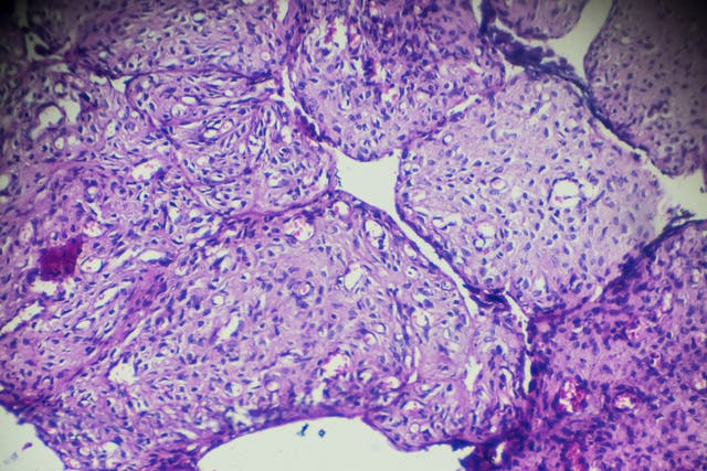 Ovary cystadenoma biopsy under light microscopy