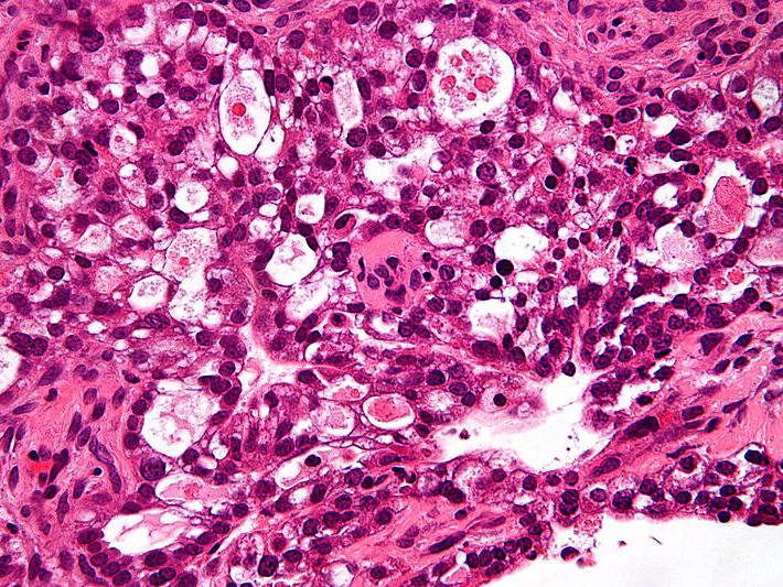 Ovarian cancer cells are sometimes misshapen, indicating a particularly dangerous strain of the disease