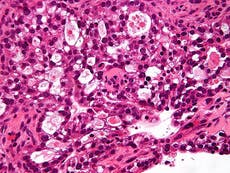 Artificial intelligence used to detect deadliest ovarian cancer