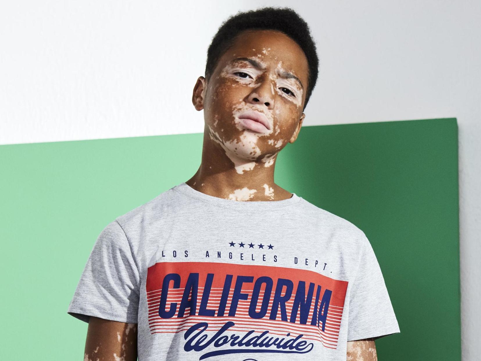 Primark praised for featuring model with vitiligo in fashion campaigns, The Independent
