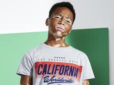 Primark praised for featuring model with vitiligo in fashion campaigns