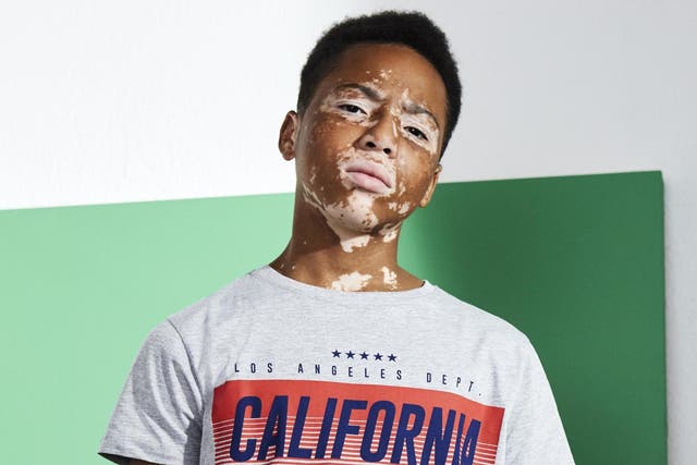Primark praised for featuring model with vitiligo in latest childrenswear campaigns